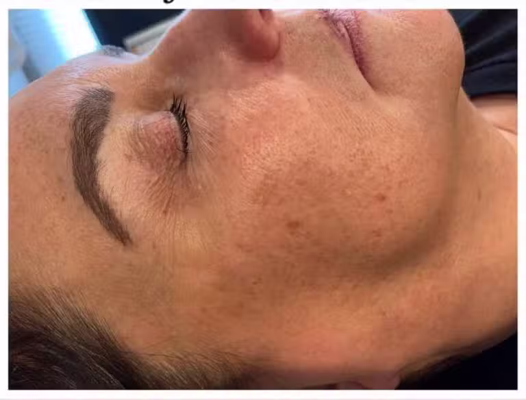 Before Image: VI Peel - front