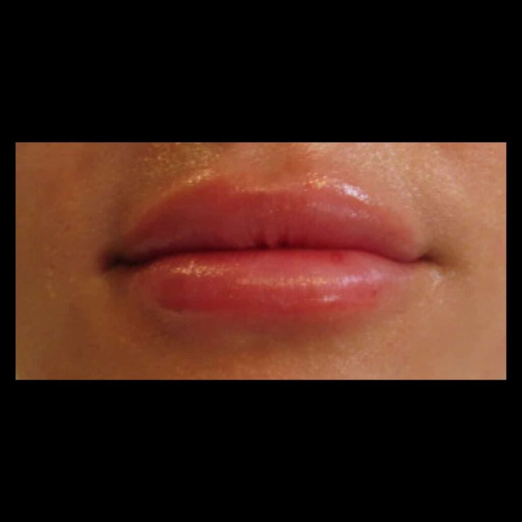 After Image: Lip Filler - front