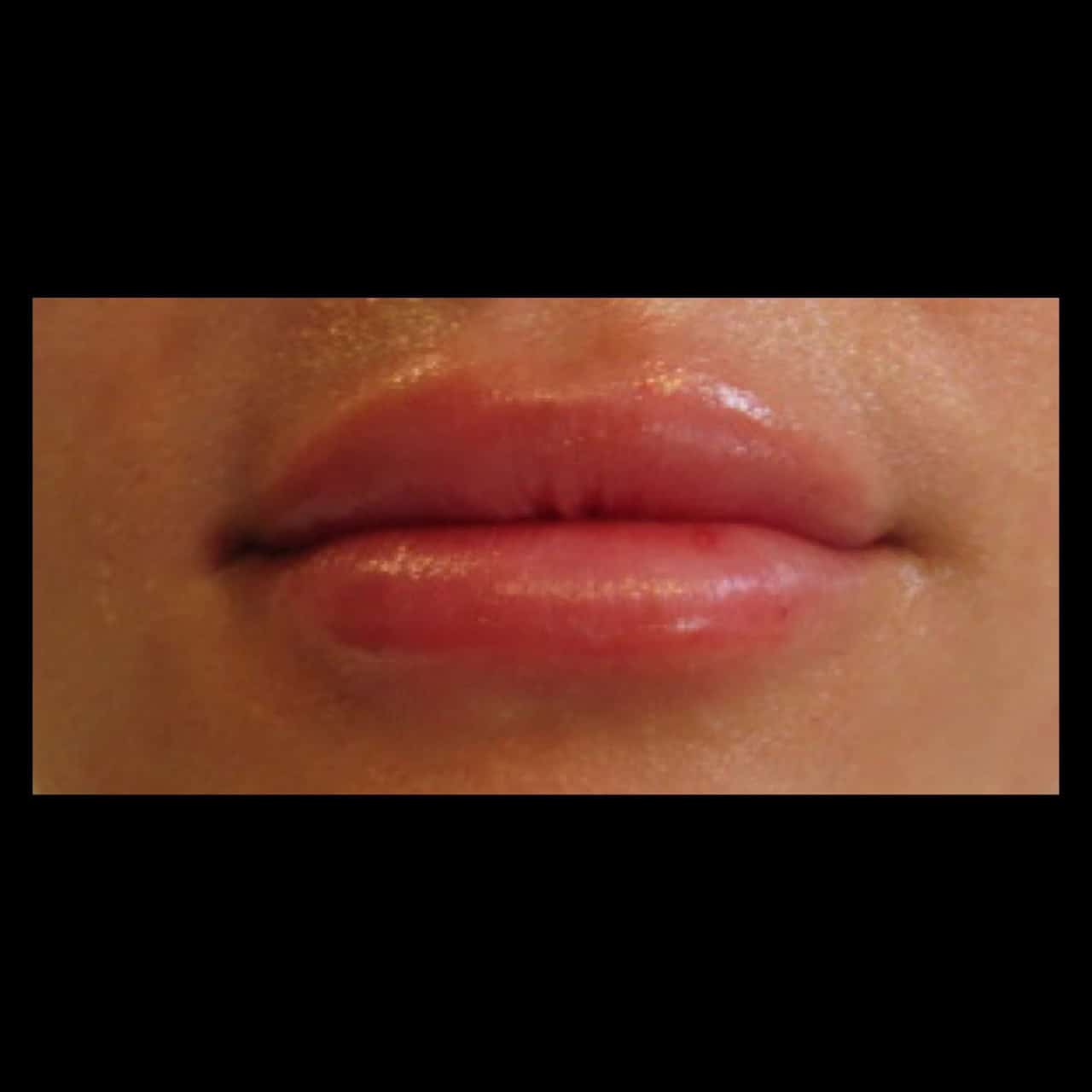 After Image: Lip Filler - front