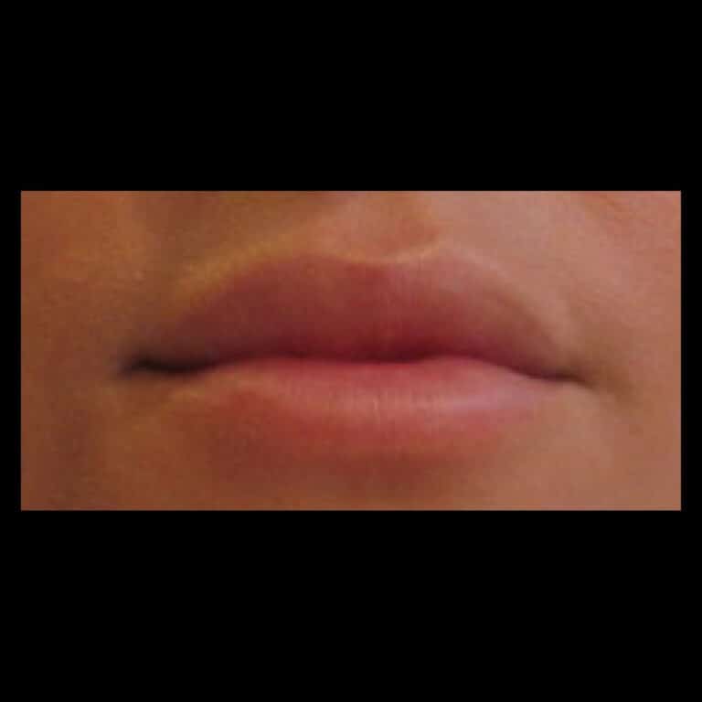 Before Image: Lip Filler - front