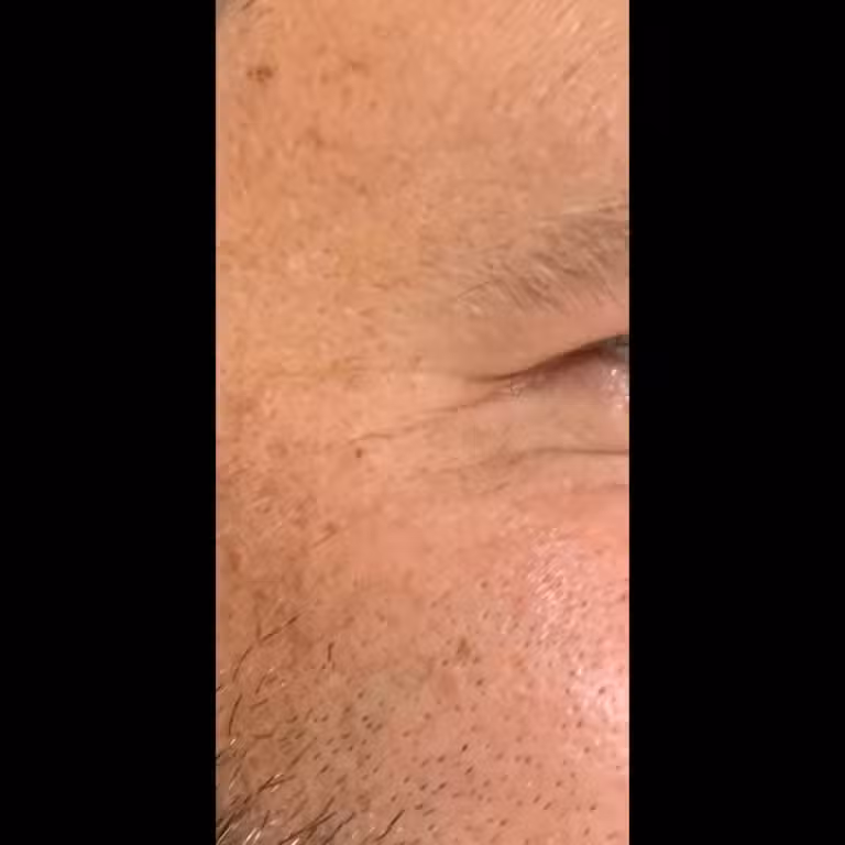 After Image: Crow’s Feet - right-side