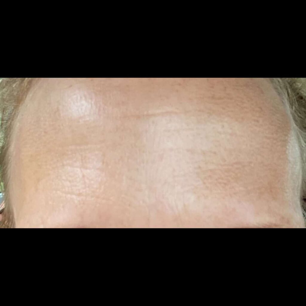 After Image: Forehead Lines - front