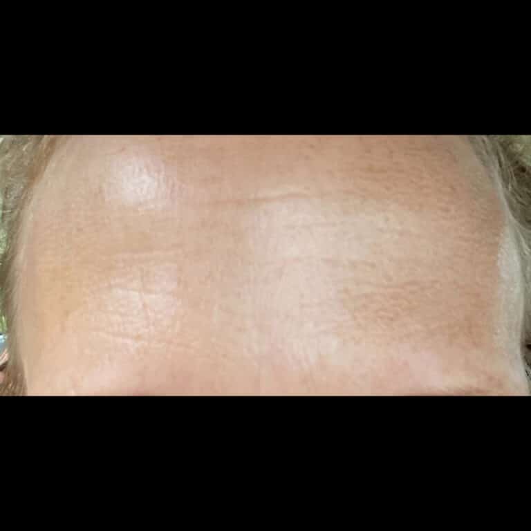 After Image: Forehead Lines - front