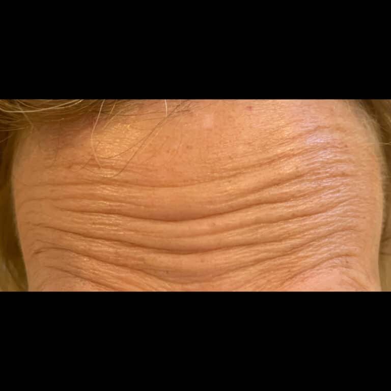 Before Image: Forehead Lines - front