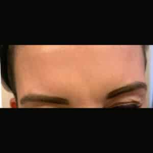 After Image: Frown Lines Between Eyebrows