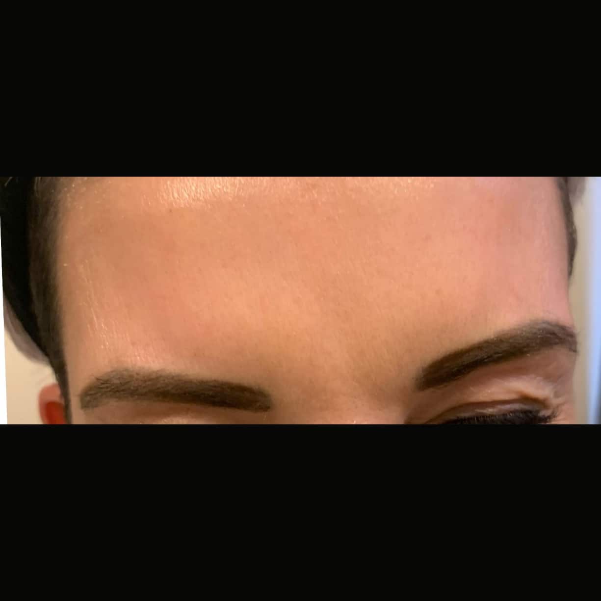 After Image: Frown Lines Between Eyebrows - front