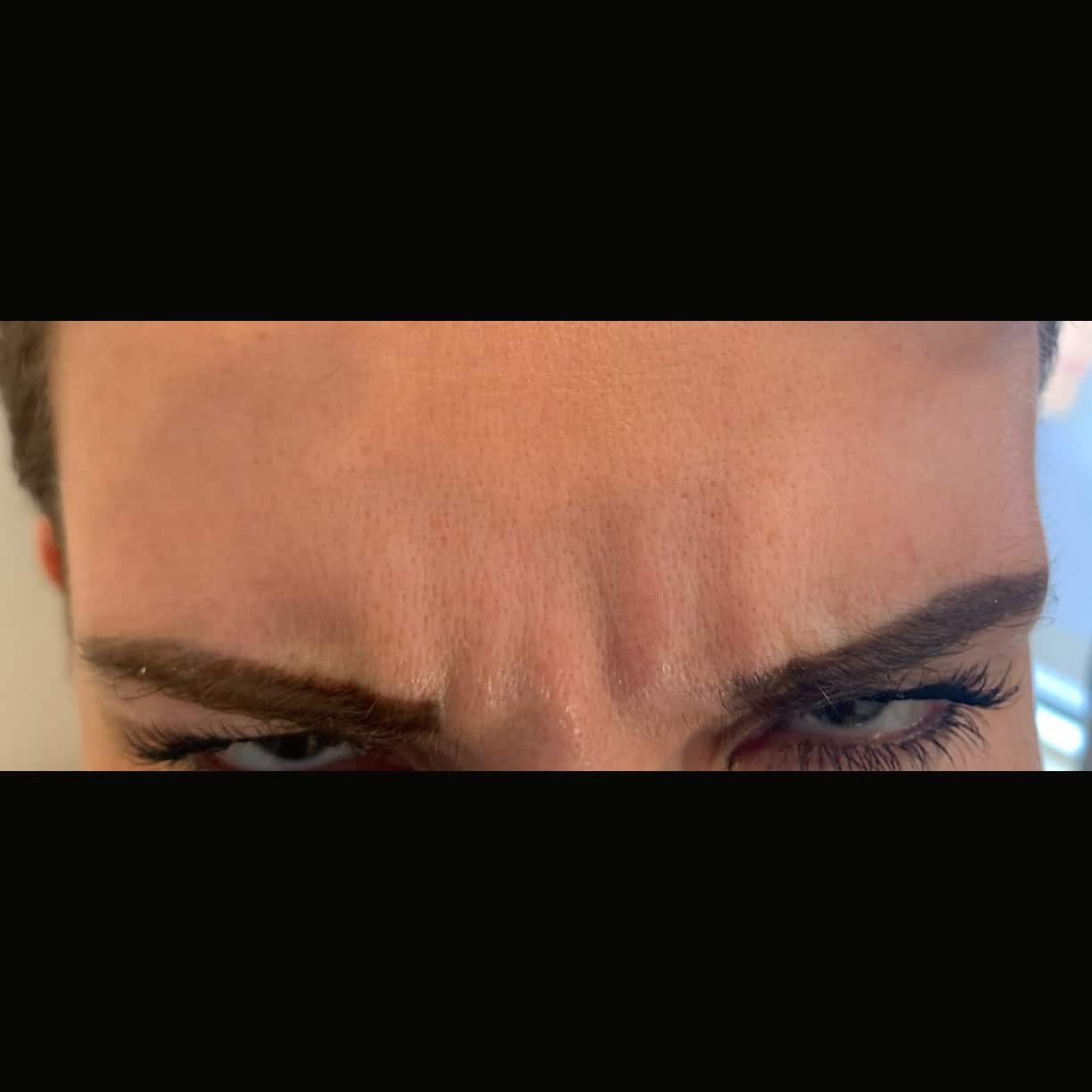 Before Image: Frown Lines Between Eyebrows - front