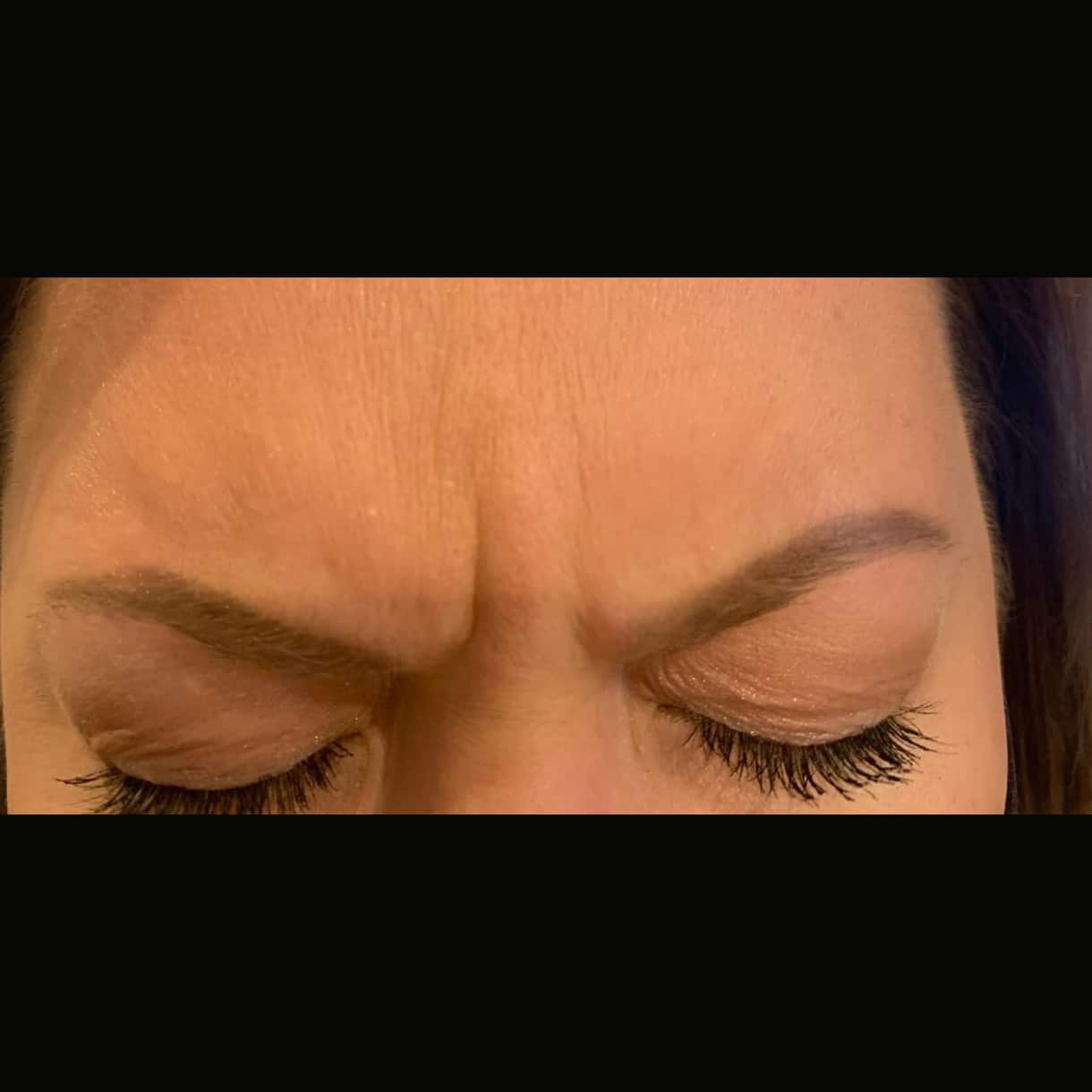 Before Image: Forehead 11’s - front