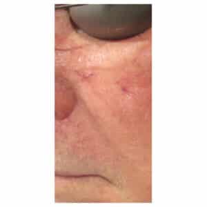 After Image: Laser Treatments