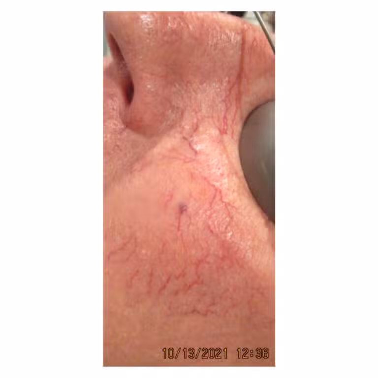 Before Image: Laser Treatments - left-side