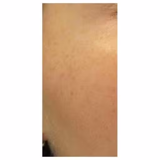 After Image: Laser Treatments - right-front-oblique