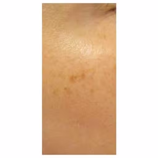 Before Image: Laser Treatments - right-front-oblique