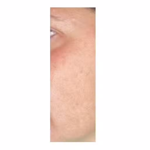 After Image: Laser Treatments - left-side
