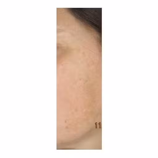 After Image: Laser Treatments - left-side