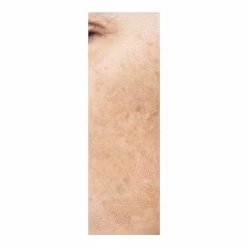 Before Image: Laser Treatments - left-side
