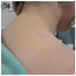 After Image: Laser Treatments - right-back-oblique