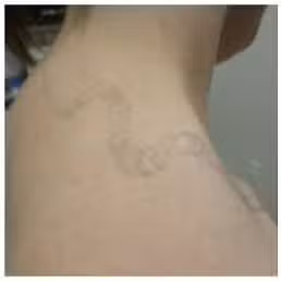 Before Image: Laser Treatments - right-back-oblique