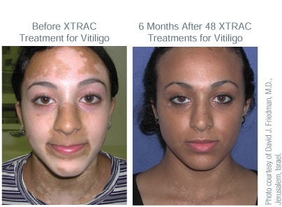 ba-xtrac-vitiligo-adult-tn