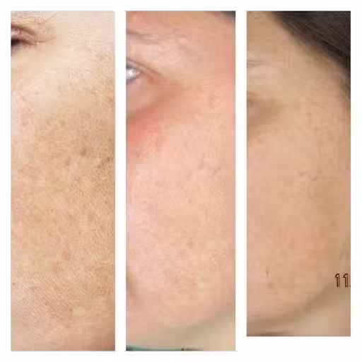 melasma-01.jpg