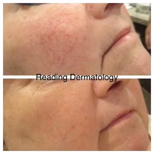 rosacea-01.jpg