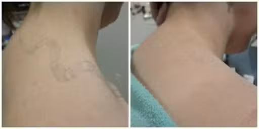 tattoo-removal-01.jpg