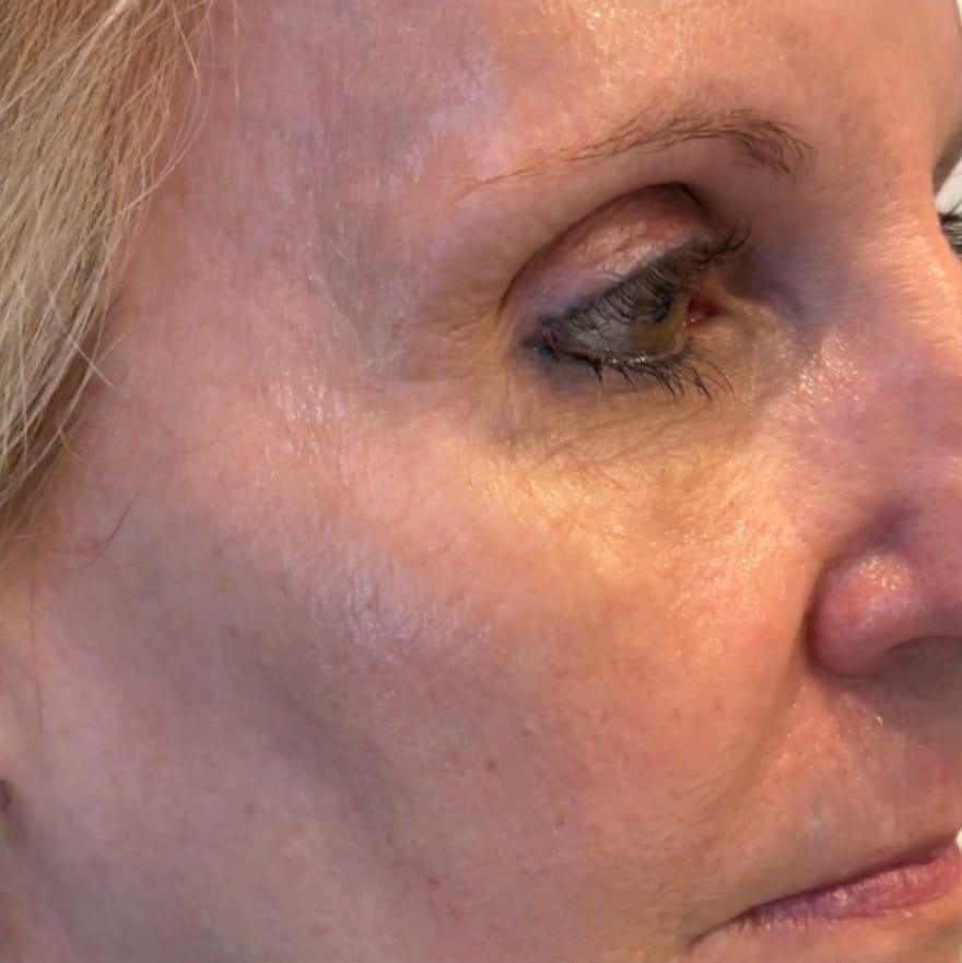 After Image: Microneedling - right-front-oblique