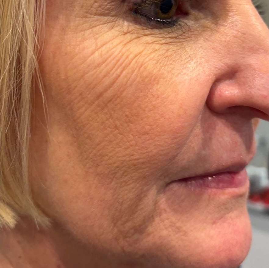 Before Image: Microneedling - right-front-oblique