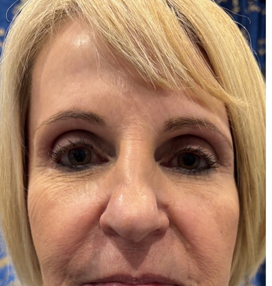 Before Image: Microneedling - front