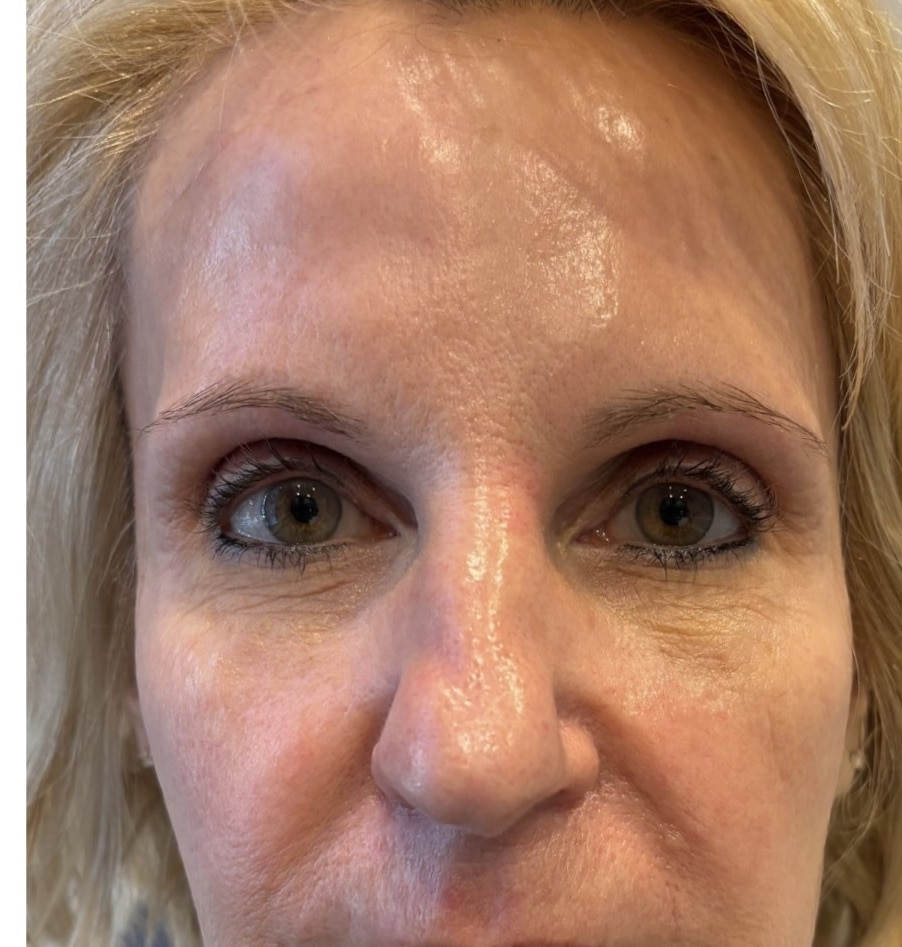 After Image: Microneedling - front