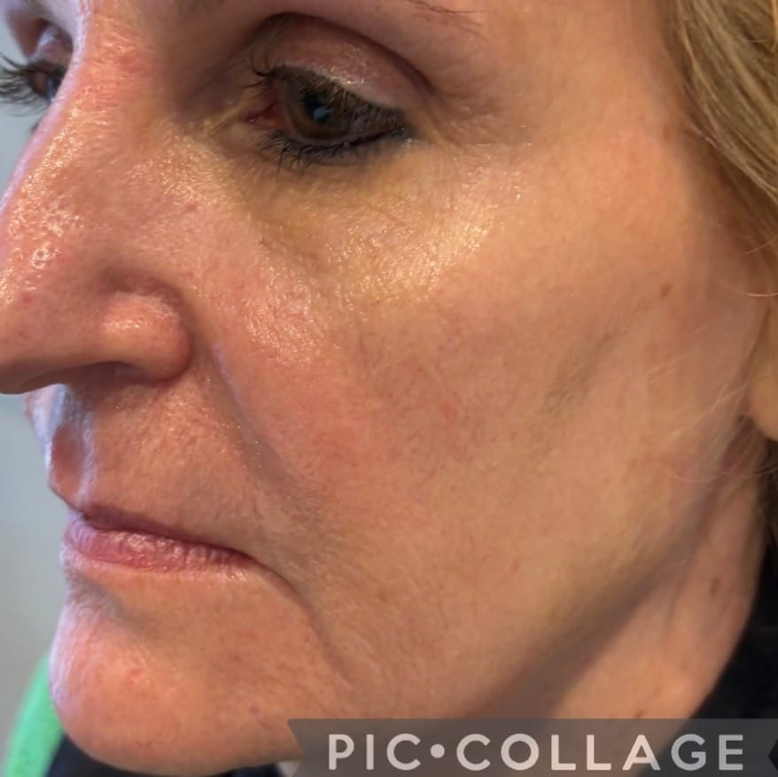 After Image: Microneedling - left-front-oblique
