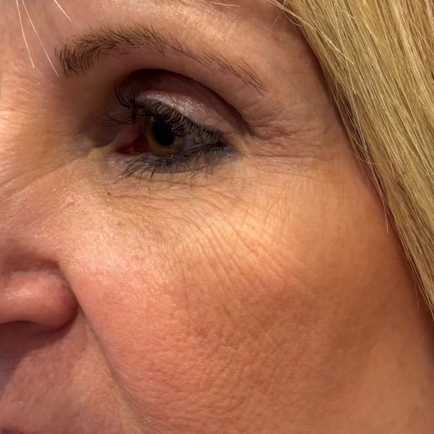 Before Image: Microneedling - left-front-oblique