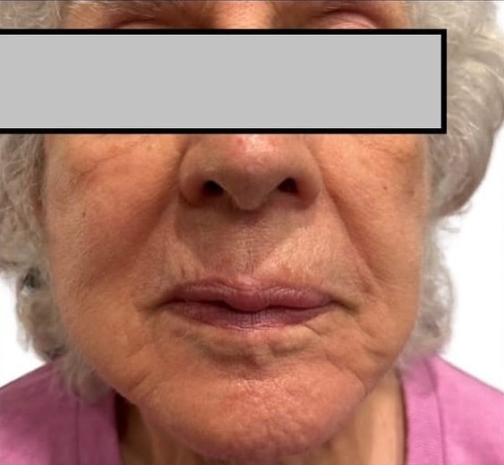 After Image: Procell Microneedling - front