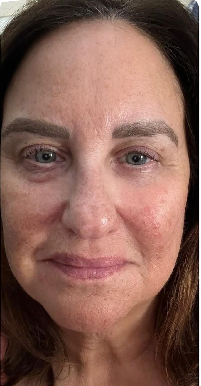 Before Image: Procell Microneedling - front