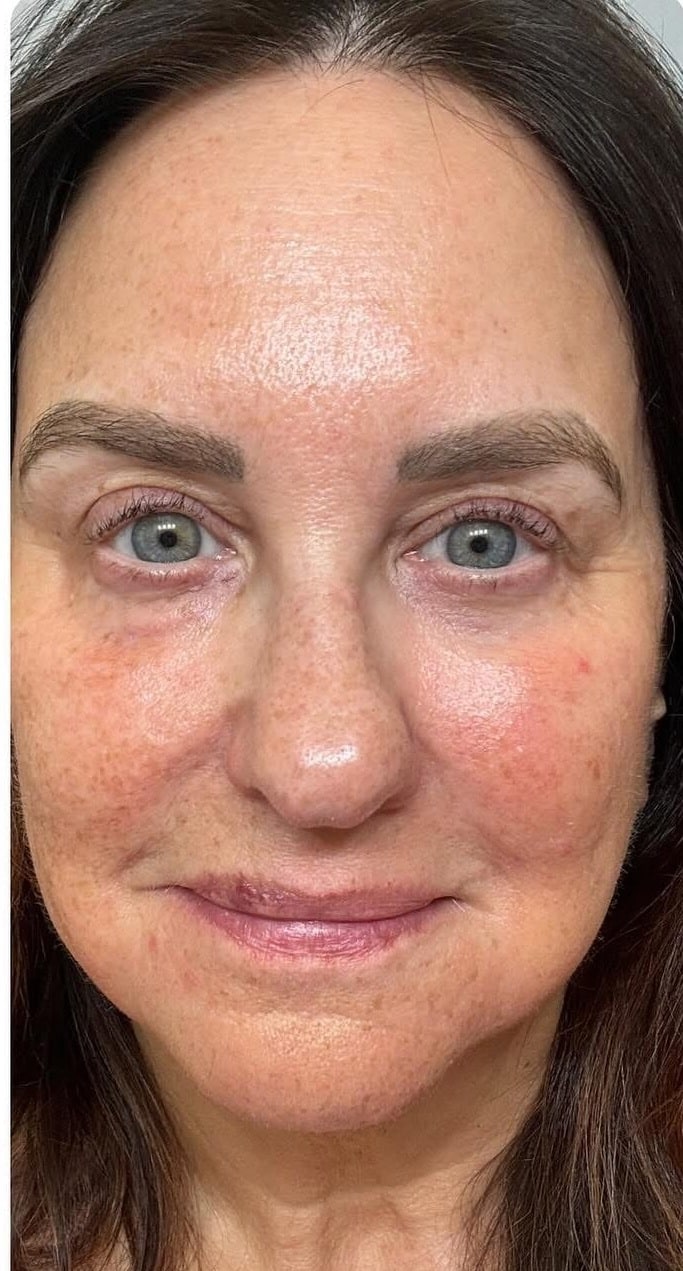 After Image: Procell Microneedling - front