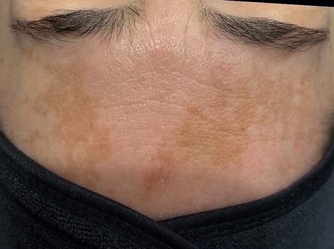 Before Image: Procell Microneedling - front