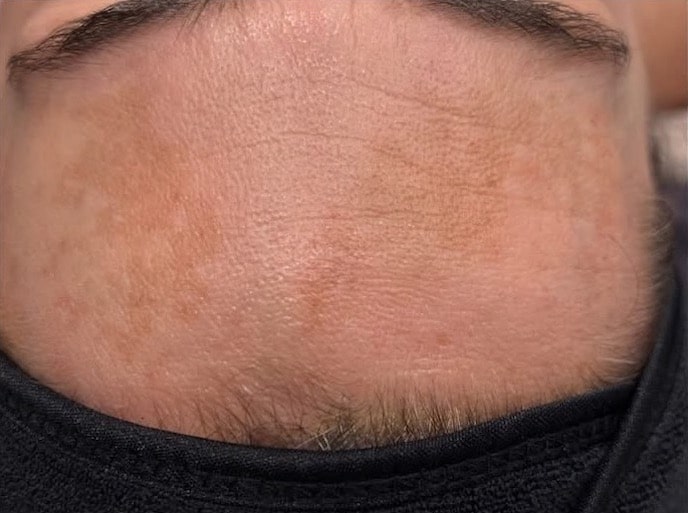 After Image: Procell Microneedling - front