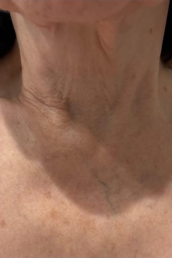 After Image: Procell Microneedling - front