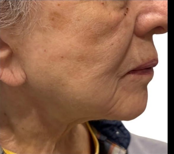 Before Image: Procell Microneedling - left-side