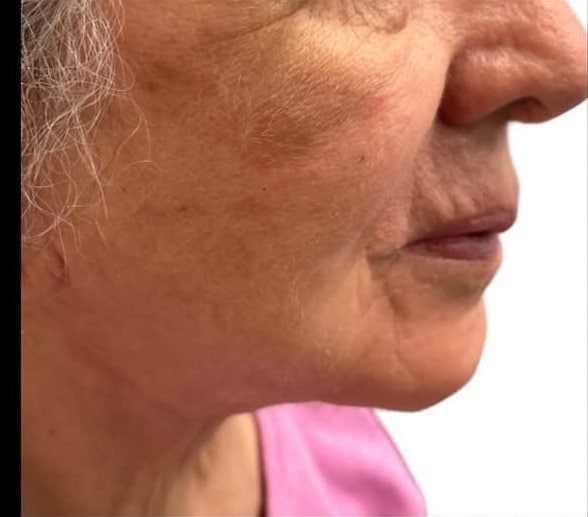 After Image: Procell Microneedling - left-side